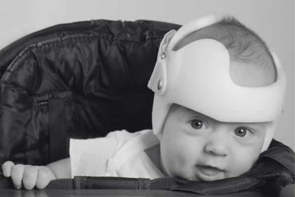 How to cure severe plagiocephaly with a helmet