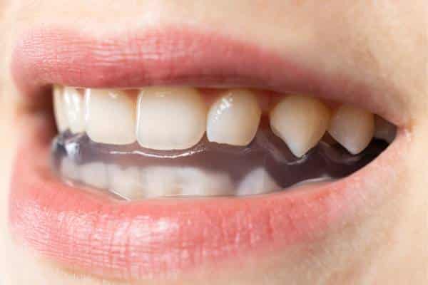 Acrylic splints to protect against bruxism