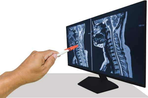 radiographie de l'arthrose cervicale